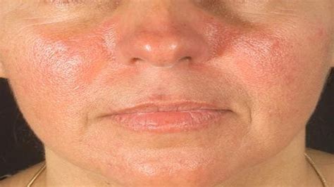 Lupus Skin Rash Treatment