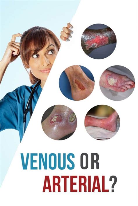 Well, there are plenty but first, you need to know what ulcer is and the difference between arterial and venous ulcers. Venous vs. Arterial Ulcers: What's the Difference? - WCEI ...