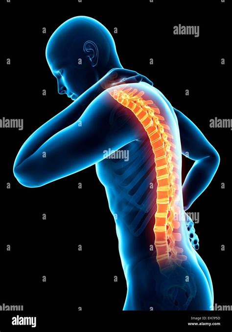 Human Back Pain Illustration Stock Photo Alamy