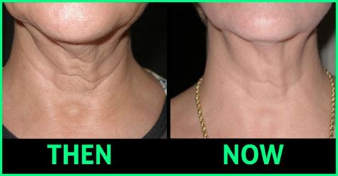 Loose Neck Skin Is Something We All Encounter But Then Isnt There A