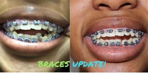 How Much Do Braces Cost In South Africa Greater Good Sa