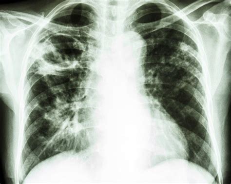 Penatalaksanaan TB MDR Alomedika