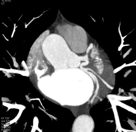 Ccta Normal Left Anterior Descending Coronary Artery Lad In 3d
