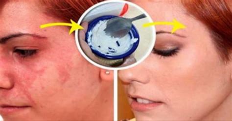 One Ingredient To Remove Them All Heres How To Solve All Your Skin