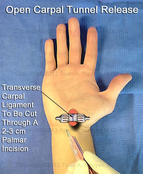 Open Carpal Tunnel Release Carpal Tunnel Syndrome Portland Hand Surgery