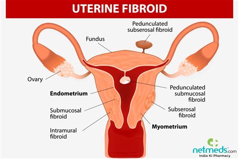 Uterine Fibroids Causes Symptoms And Treatment