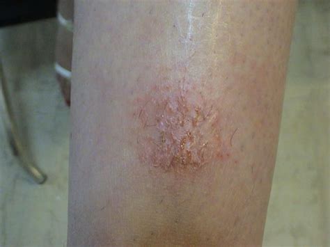 Dermatitis Ekzema Nummular Eczema Picture Hellenic Dermatological