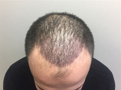 Fue Hair Transplant After 1 Week Marc Dauer Md Hair Transplant