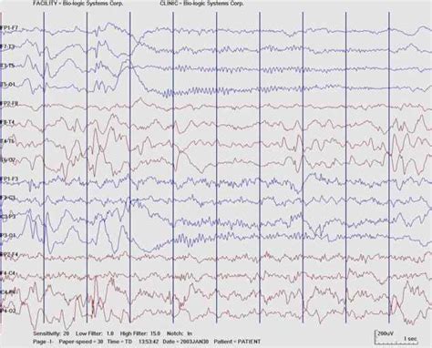 Periodic Epileptiform Discharges 41 Introduction Conduction Studies