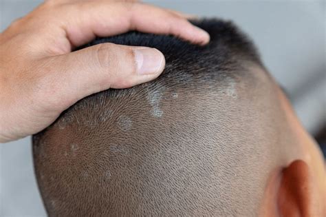 3 Signs Of Eczema On The Scalp Hair Loss Topic