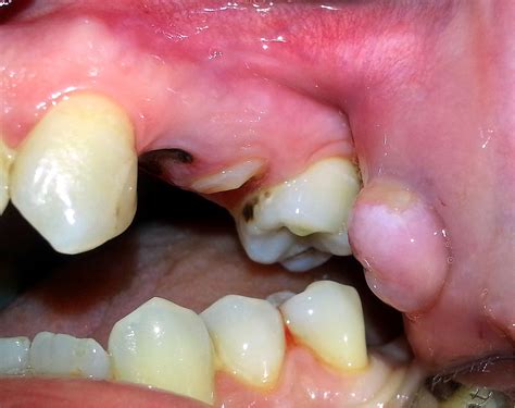 Co to jest leukoplakia Objawy przyczyny i leczenie chorób jamy ustnej