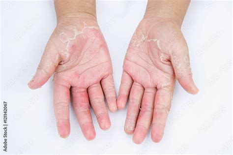 Dry Hands Peel Contact Dermatitis Fungal Infections Skin Inf Stock