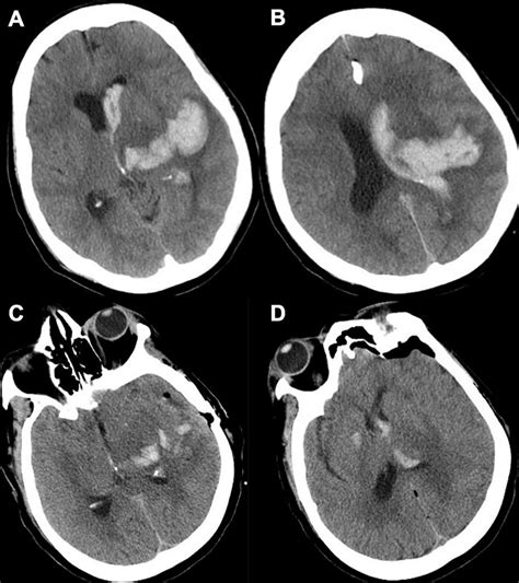 A B Non Contrast Head Ct Axial Demonstrating A Left Basal Ganglia