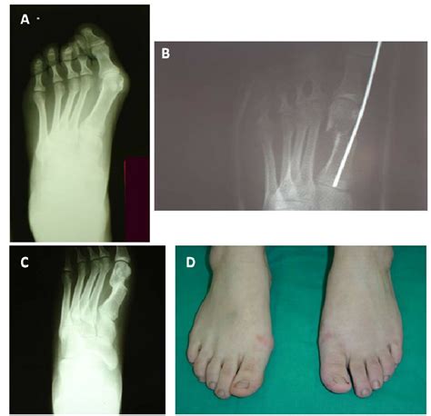 13 Years Old Female With Hallux Valgus Deformity Of The Left Foot The