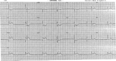 Abnormal Ecg Showing Typical Inferior Myocardial Infarct Download