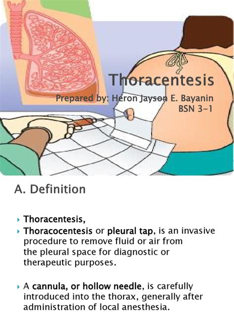 Thoracentesis Pdf Diseases And Disorders Health Sciences