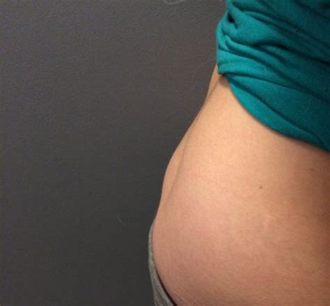 Unfortunately, you can't stretch it back into place; Anyone else's tailbone stick out after childbirth ...