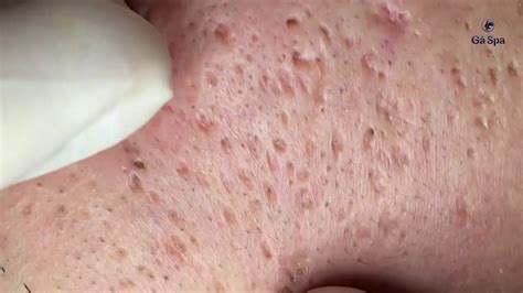 Blackhead Acnes Just Touch The Skin So Many Acne Bounce Off Youtube