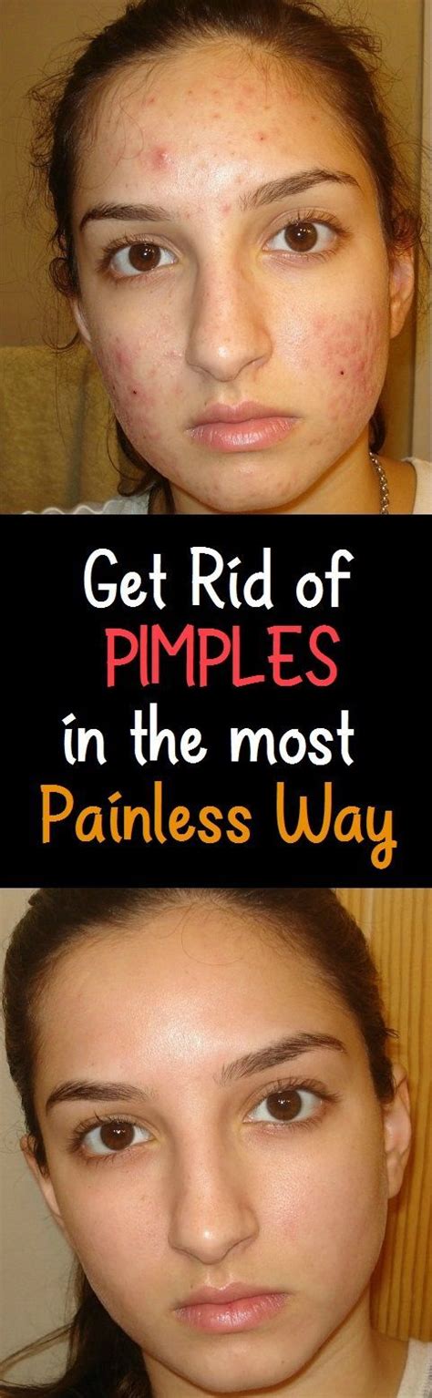 Get Rid Of Pimples In The Most Painless Way How To Get Rid Of Pimples
