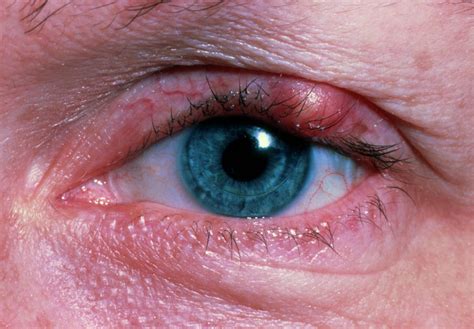 Stye Hordeolum On Patients Upper Eyelid Photograph By Sue Ford