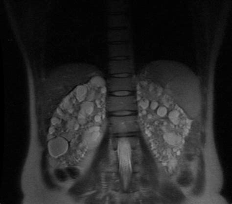 Polycystic Kidney Disease With Chronic Pancreatitis Ct And Mri Sumers