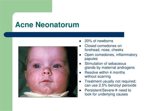 Acne Neonatorum Vs Erythema Toxicum