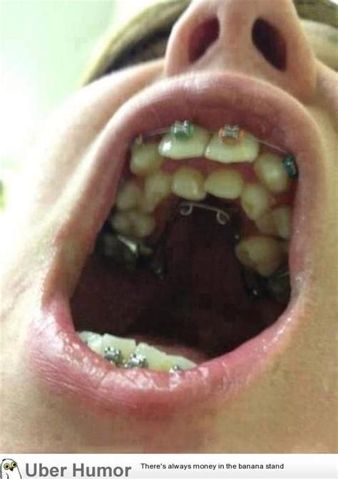 Orthodontic Wet Dream Funny Pictures Quotes Pics Photos Images