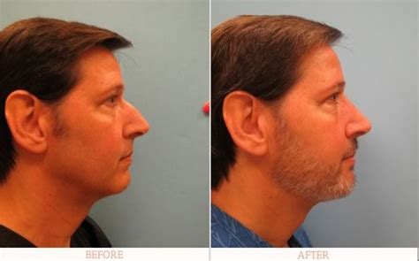 men s plastic surgery before and after wittnerdavid
