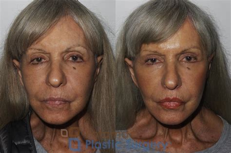 upper lip lift to enhance lip volume in an older woman