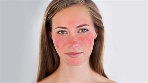 What You Can Do About Red Sensitive Or Inflamed Skin
