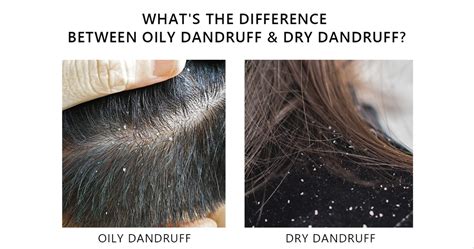 Dandrene Dandruff Shampoo And Conditioner Bundle By Ds Laboratories