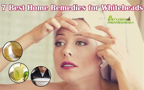 7 Best Home Remedies For Whiteheads On Face And Nose That Work