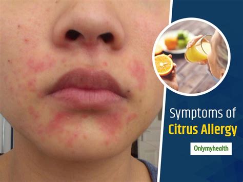 Citrus Allergy Symptoms Foods To Avoid And More Onlymyhealth