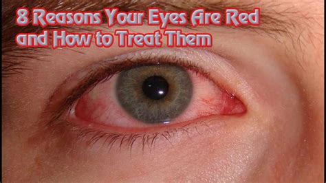 Reasons Why Your Eyes Are Red And How To Treat Them