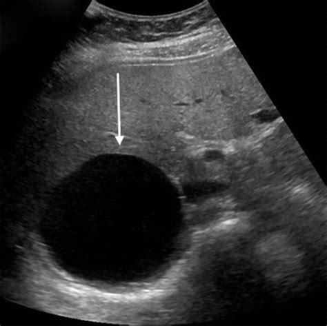 Imaging Of Nonmalignant Adrenal Lesions In Children Radiographics