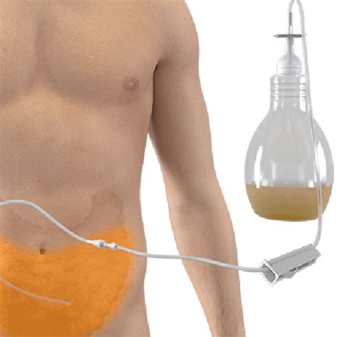 Pleural Effusion Catheter