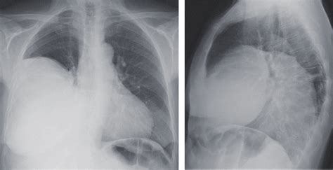 Chest X Ray Lateral View Of A Large Sftp Located In The Right