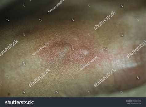 Close Skin Swelling Mosquito Bites Stock Photo 1528087850 Shutterstock