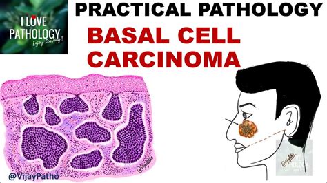 Basal Cell Carcinoma Clinical Features And Morphology Youtube