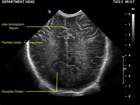 Practical Guide To Neonatal Cranial Ultrasound Crus Basics