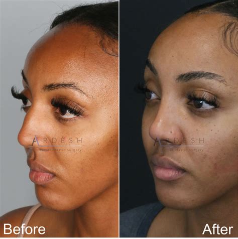 rhinoplasty before and after 01 ardesh facial plastic surgery