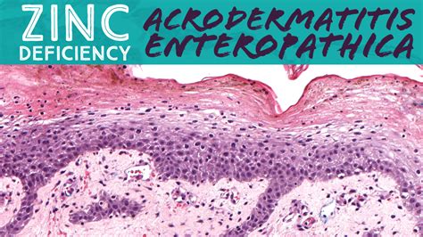Nutritional Deficiency Acrodermatitis Enteropathica Due To Zinc