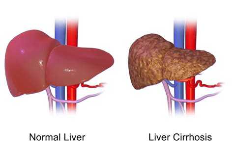 Common Complications Of Cirrhosis