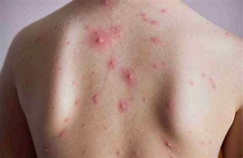 Get Vaccinated Against Chickenpox People Told