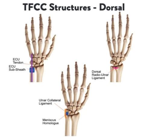 Ulnar Sided Wrist Pain E Book Hand Therapy Academy