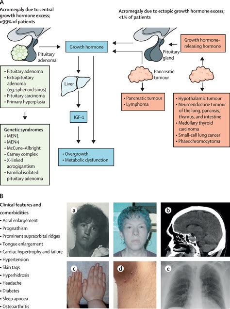 Acromegaly Pathogenesis Diagnosis And Management The Lancet