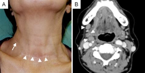 Skin Incision And Postoperative Enhanced Ct Study A Total