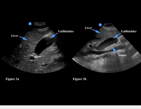 A The Gallbladder Is A Hypoechoic Dark Structure Which Generally