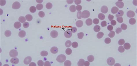Cureus A Case Report Of Babesiosis Seen Outside Of Its Endemic Area