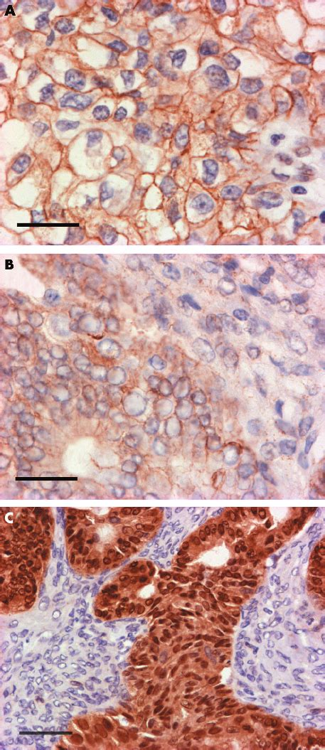 A A Clear Cell Ovarian Cancer Showing Strong Continuous Expression Of